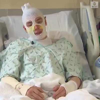 Derrick Byrd, 20, sustained second- and third-degree burns on his face, arms, and back after rushing back into a burning home to save his 8-year-old niece. Derrick Byrd is the definition of a true hero. ?