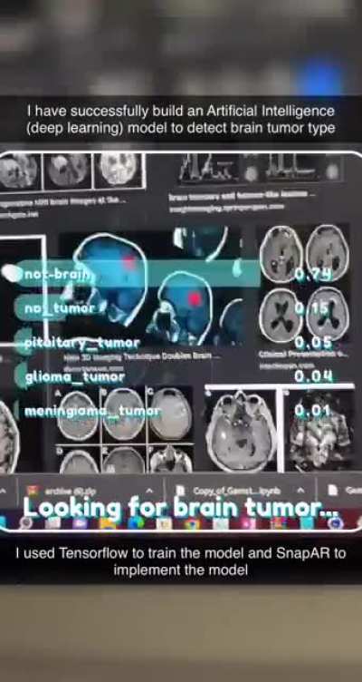 I have successfully built an Artificial Intelligence (deep learning) model to detect brain tumor type through mobile camera using Snapchat filter.