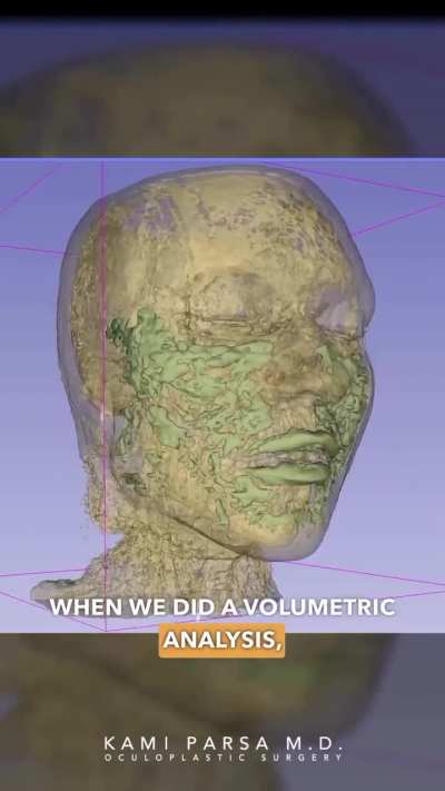 An MRI of a 33-year-old woman reveals that the amount of fillers injected into her face has doubled!