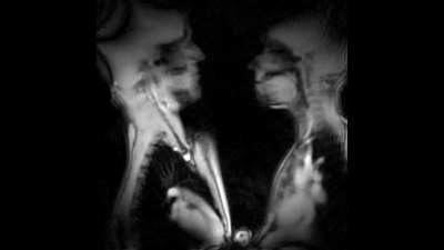 Kissing in MRI