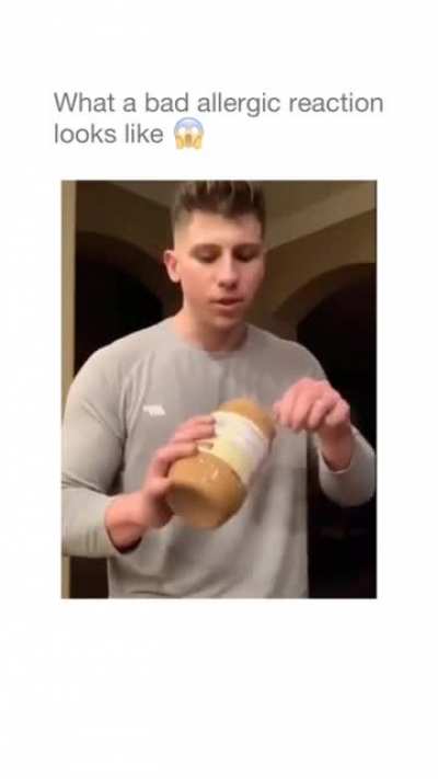 Peanut Butter Allergy