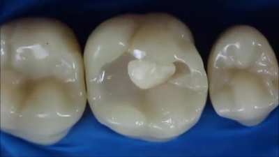 Dental composite resins allow for the seamless repair of a large hole in a tooth ?