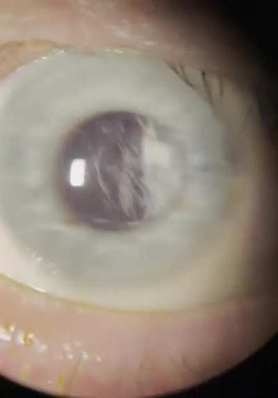 Snow globe eye. Asteroid hyalosis is a condition where people have calcium deposits floating around in the eye