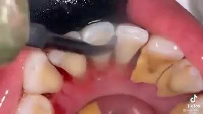 The gums are gone- (Sorry if repost )