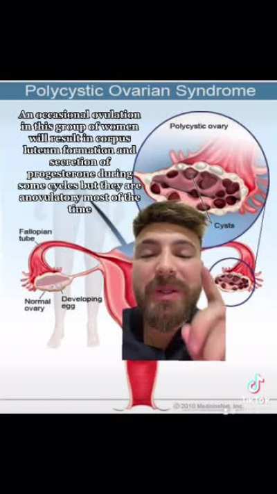 Hello guys ( i guess girls in this case ?),here is a video to explain PCOS for curious people and those affected by it, hope you enjoy it, any constructive feedback is welcome ?