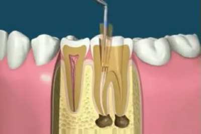 Educational, but brutal. Gif of a Root Canal