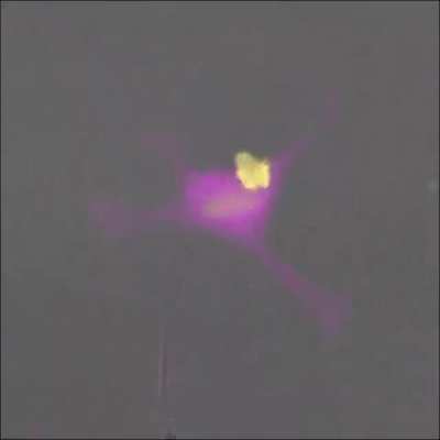 This immune cell soldier (yellow) fights a highly aggressive cancer cell (magenta).
