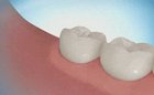 How a wisdom tooth is removed