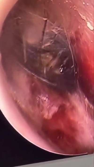 Spider crawls in a guy’s ear while he slept