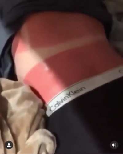 WCGW sunbathing without protection.