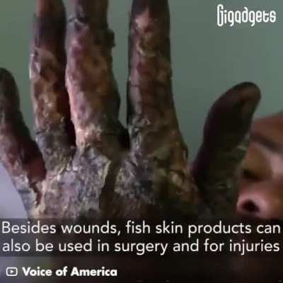 These special fish skin bandaids are being used to help treat skin burns