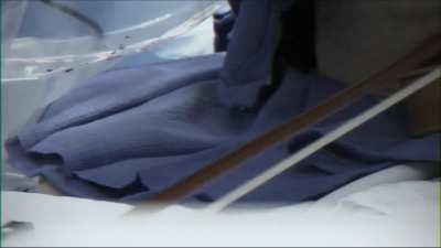 Professional violinist's tremors calmed by deep brain stimulation implant | from The Mayo Clinic by Ken Burns