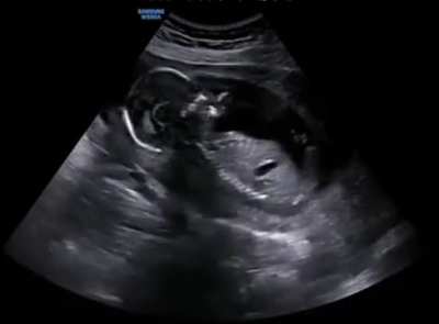 Ultrasound of a pregnant woman laughing