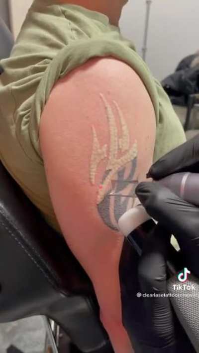 They’re zapping tattoos