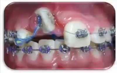 Watch braces in action, repairing unrepairable gnarly teeth.