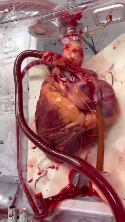 Human heart waiting to be transplant