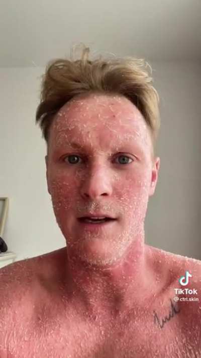 Topical Steroid Withdrawal awareness