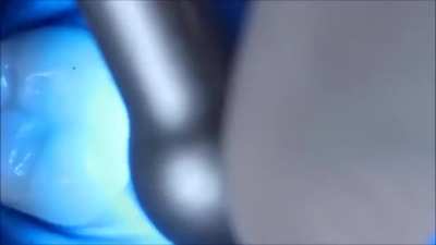 Dental composite resins allow for the seamless repair of a large hole in a tooth ?