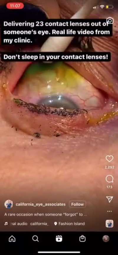 23 contact lenses being removed from an eyeball