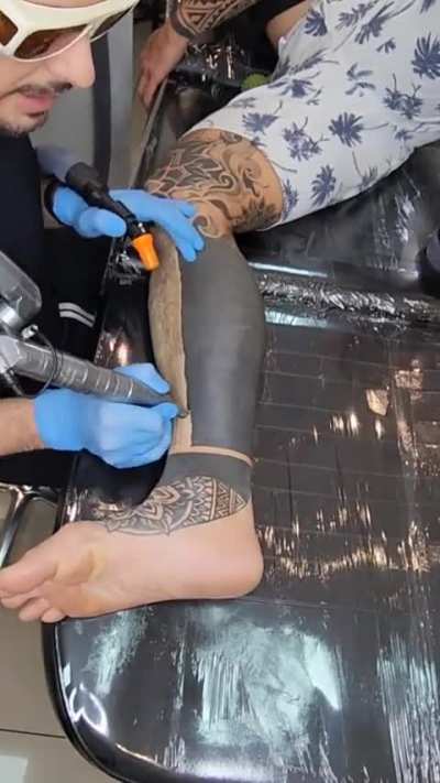 This tattoo removal